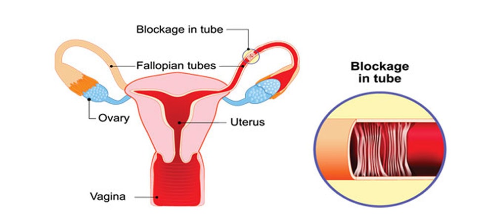 Womb and Fallopian Tube Treatment
